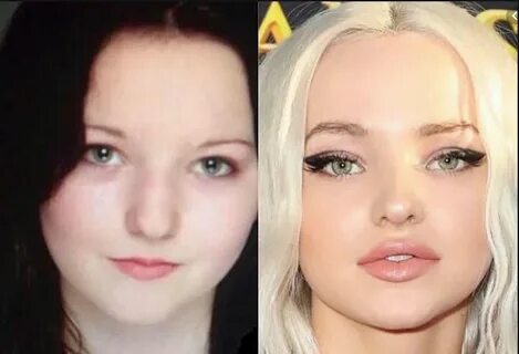 Did Dove Cameron Undergo Plastic Surgery Including Lips and 