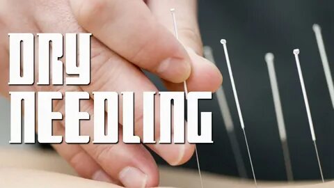 Prick it where it’s tight! Dry-needling and how it differs f