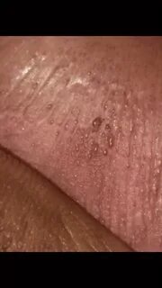 Tiny Bumps On Penile Tip