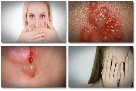 what causes herpes Archives Herbs For Herpes
