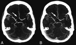 Timing-Invariant CT Angiography Derived from CT Perfusion Im