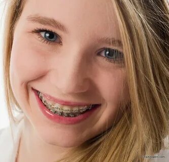 Orthodontics & Braces Oral Answers