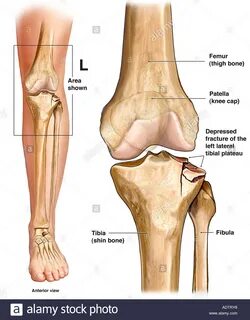 Tibial plateau fracture hi-res stock photography and images 