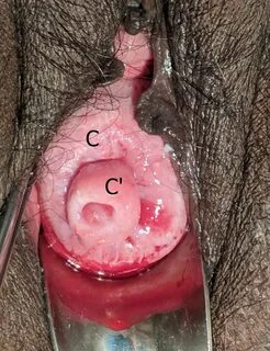 Journal of Postgraduate Gynecology & Obstetrics: Cervix with