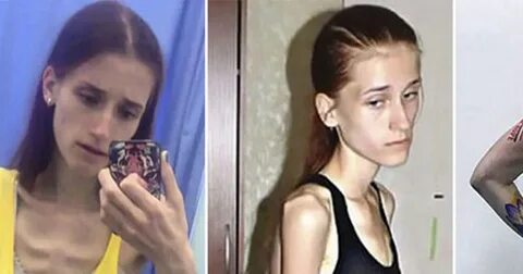 Teen who suffered from severe anorexia turned her life aroun