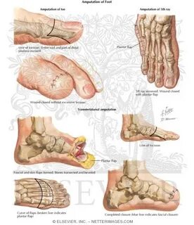 Toe Amputation - Transmetatarsal Amputation