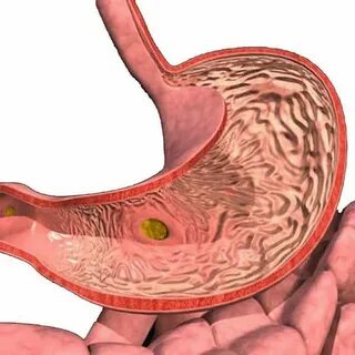 Gastritis of the stomach in adults: types, causes, symptoms,