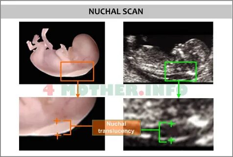Down Syndrome Ultrasound Pictures 20 Weeks