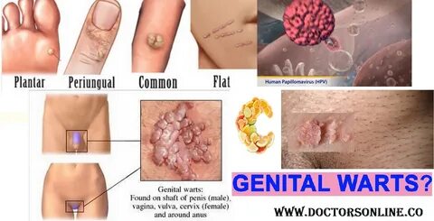 How many kinds of warts are there - Ngify