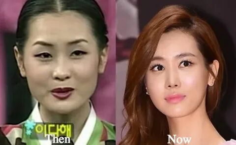 Lee Da Hae Plastic Surgery Before and After Photos - Latest 