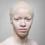 Альбинос: кто такой, 3 типа альбинизма, способы лечения, сов