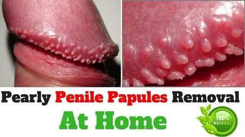 Effective Pearly Penile Papules Removal - YouTube