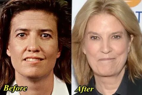 Greta van Susteren Plastic Surgery Before and After - Plasti