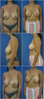 Breast Reduction Surgery Before & After Photo - Case 121.