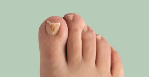 Find Fitness Idea - How to Prevent Nail Infection? A Few Eas