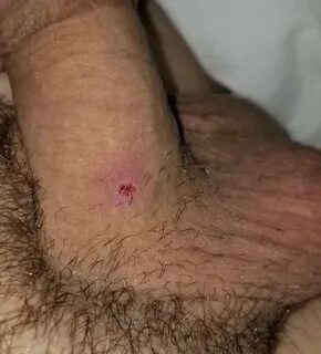 Cant tell if i have a std or ingrown hair Genital Herpes Sim