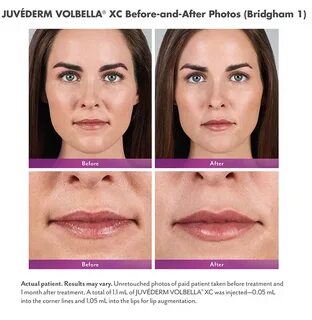 JUVÉDERM VOLBELLA ® - Hayes Valley Medical & Esthetics