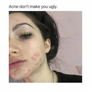 I have them too anf its ok Girl with acne, Acne, Bare beauty