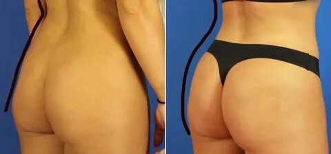 Brazilian Butt Lift Surgery Madison & Milwaukee Quintessa