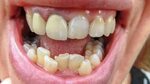 Why teeth grow crooked: how to align teeth? - Healthy Food N