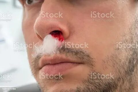 Junger Mann Mit Nasenbluten Hat Watte Im Nasenloch Stockfoto