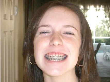 Em-With & Without Braces