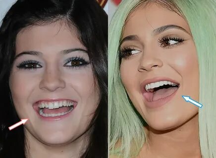 Kylie Jenner, Before and After Transformation