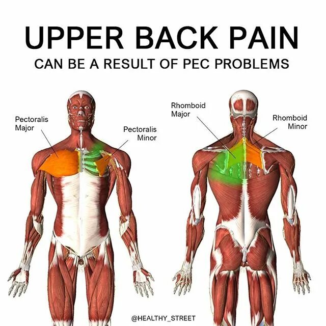 చిత్రంలోని అంశాలు: 'UPPER BACK PAIN CAN BE A RESULT OF PEC PROBLEMS Pe...