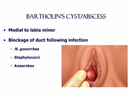 Benign diseases of the vulva, vagina and cervix - ppt video 