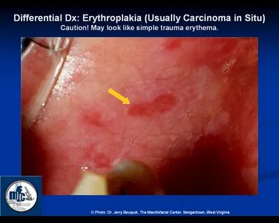 Erythroplakia. Causes, symptoms, treatment Erythroplakia