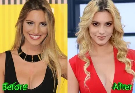 Lele Pons Nose Job: A Good Idea and A Good Result