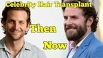 20 Celebrity Hair Transplants Before and After - YouTube
