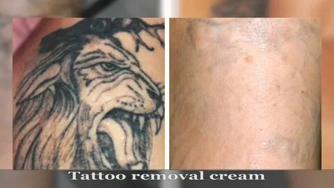 Ink Bomb Tattoo Removal - Tattoo Designs