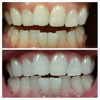 Dentist Teeth Cleaning Before And After - anyoneforanya