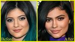 Kylie Jenner Before & After Plastic Surgery! + (Leaked Photo