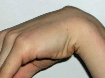 Überbein - Ganglion an der Hand: Operation sinnvoll? Gesundh