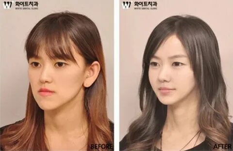 Фотофакты. Другое лицо: до и после чуда корейской пластическ