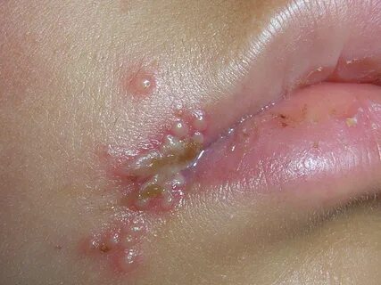 Herpes simplex/Lippenbläschen - DEXIMED - Deutsche Experteni