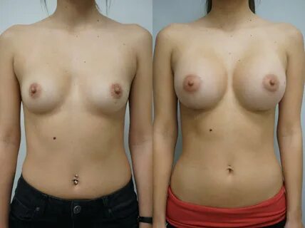 Breast Augmentation Before and After Pictures Case 136 Gilbe. 