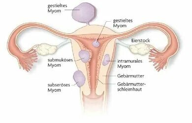 Gebärmutterentfernung (Hysterektomie) Apotheken Umschau