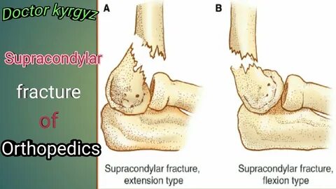 Supracondylar fracture, classification, C. Features, treatme