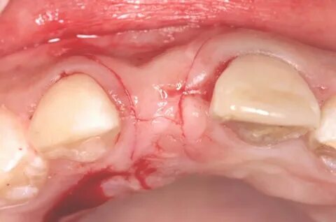 Using Papillae-Sparing Incisions in the Esthetic Zone to Res