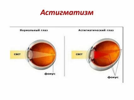 Сложный астигматизм бывает миопическим и гиперметропическим,