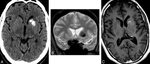 A 50-year-old man presenting with headache. A, Noncontrast C