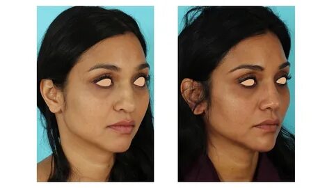 Fai Khadra Before Nose Surgery - Haya Khadra is seen on Augu