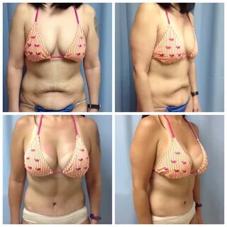 Tummy Tuck All Inclusive Cost: $8,800 - $10,800 Time Off: 10 Days.
