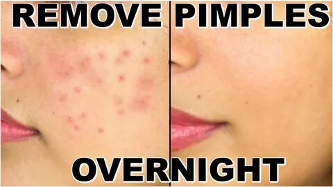 Natural Remedies to Get Rid of Pimples Overnight Fast