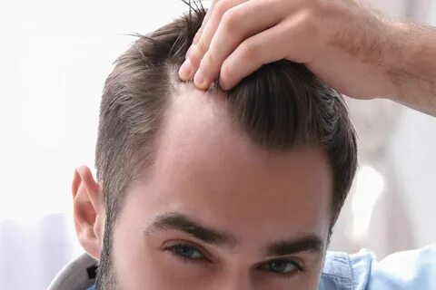 Receding hairline: why it happens and how to fix it - Insala
