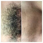 Brazilian Wax Before After Pictures - Topenar