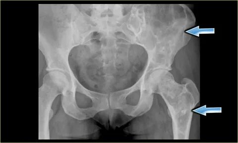 The Radiology Assistant : Bone tumor A-G